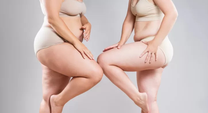 lipödem bacak görseli